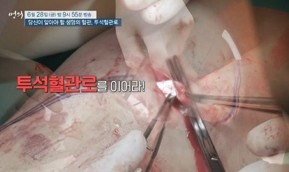 투석혈관로