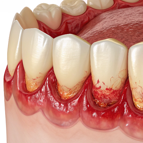 잇몸병을 앓고 있어서 잇몸에서 출혈이 발생하는 이미지