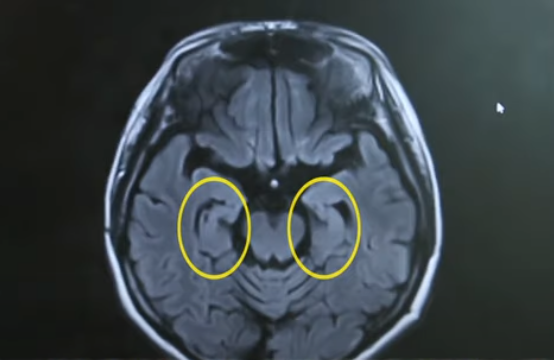 양쪽에 위치하고 있는 헤마가 위축돼 있는 모습