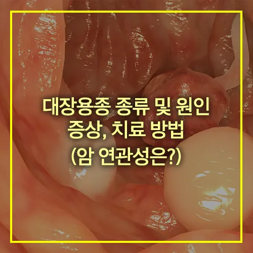 대장용종 종류 원인 증상 치료
