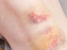 몸에 멍이 잘드는 이유