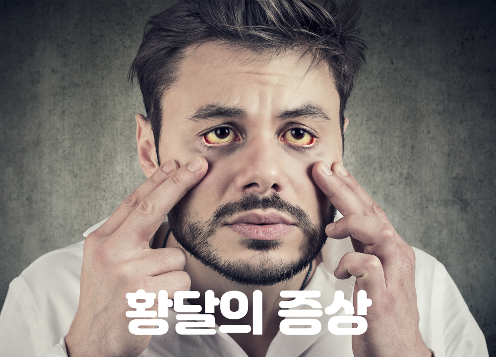 황달의 증상 이미지입니다.
