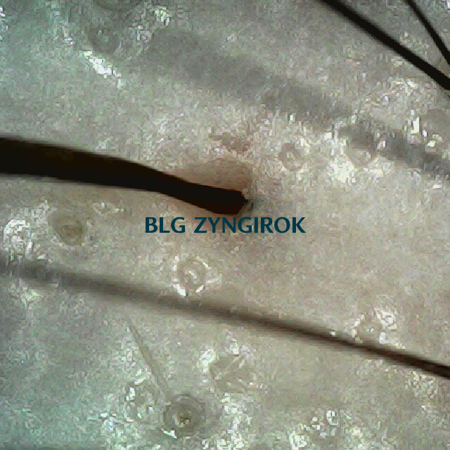 피나모아 복용 18주차 - 정수리와 이마 사이 부분 두피 모습이다.