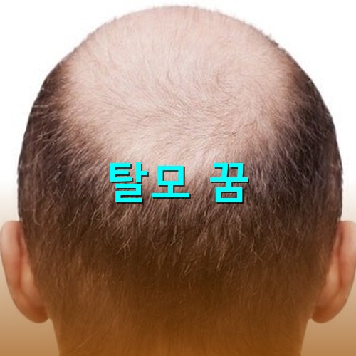 머리가-점점-빠져-대머리가-되가는-모습