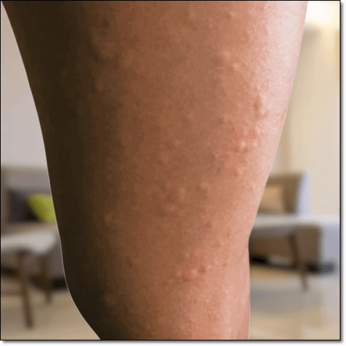 한랭 두드러기 원인