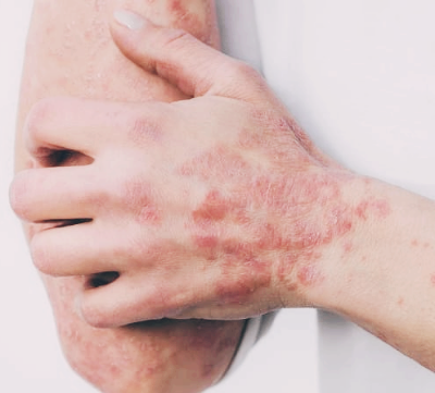 염증수치 낮추는 방법