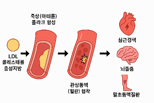 고지혈증이 초래하는 합병증 총정리｜심근경색부터 뇌졸중(뇌졸증)까지