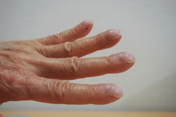 손가락이 &lsquo;이 모양&rsquo; 이라면&hellip; 당장 병원부터 가세요.