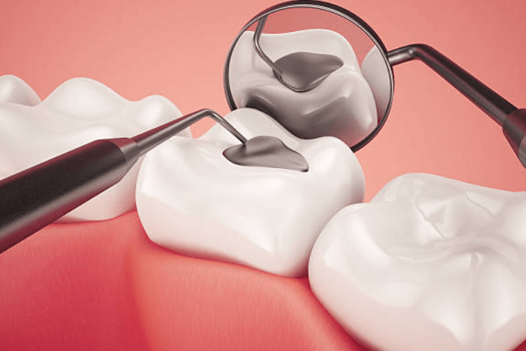 충치 치료 실비