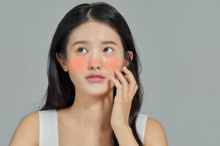 뺨과-코가-붉은-주사피부염의-여성