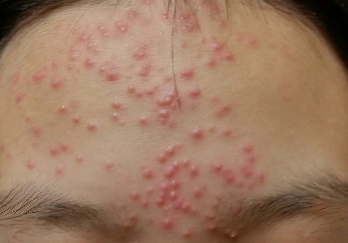 여드름 예방 방법으로 치료해야 할 이마의 여드름