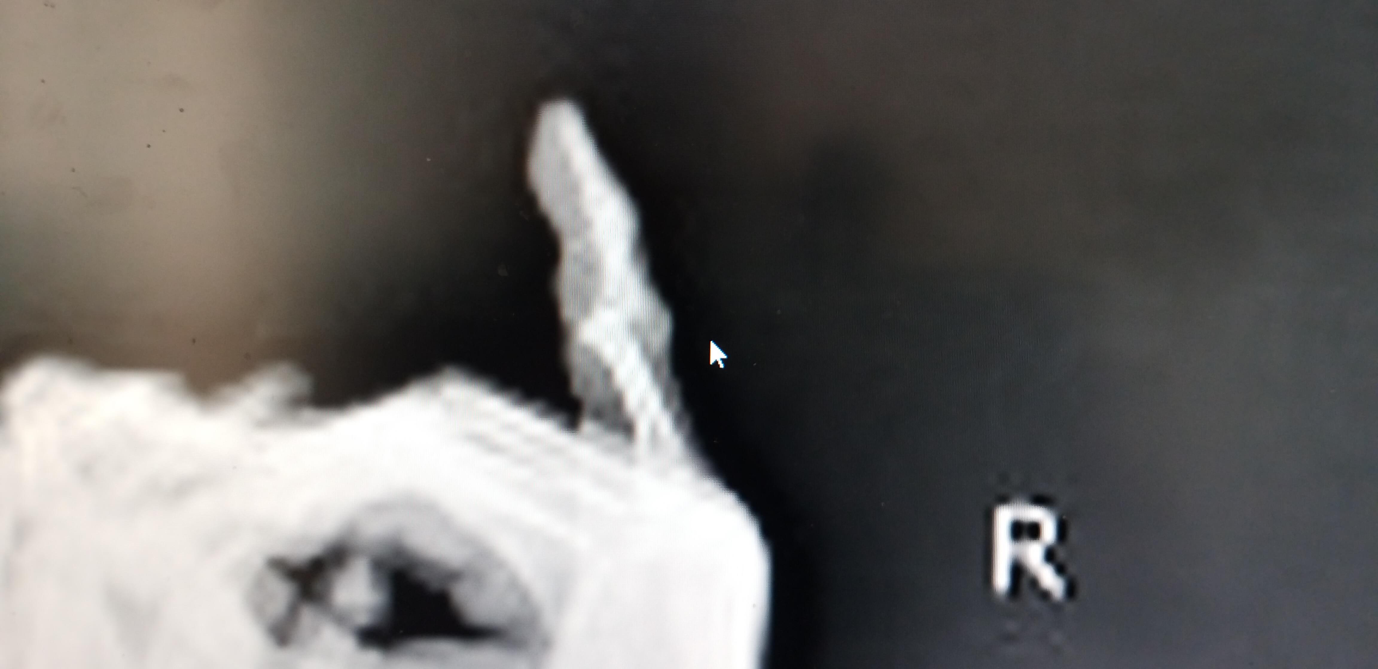 손가락인대파열사진3