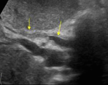 담관염(Cholangitis)