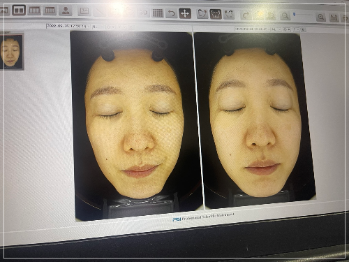 루비레이저 전후