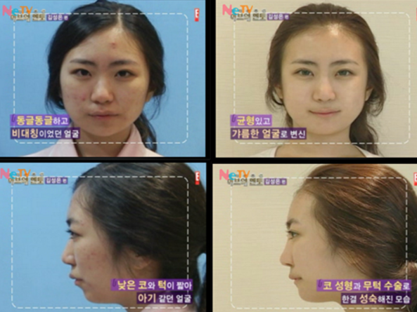 미달이 김성은 노출 성형