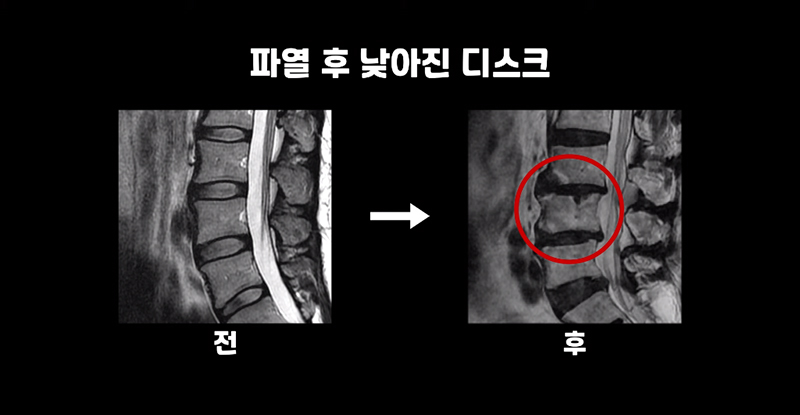 허리디스크 파열사진
