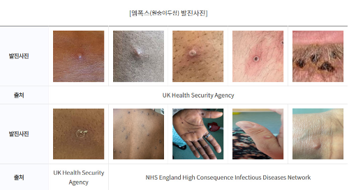 알트태그-엠폭스 증상 사진