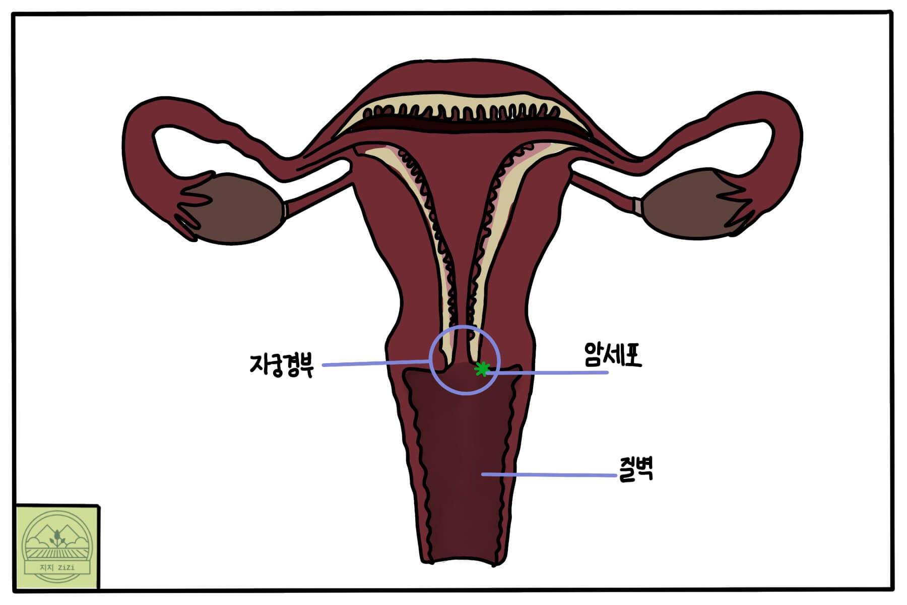 자궁경부암