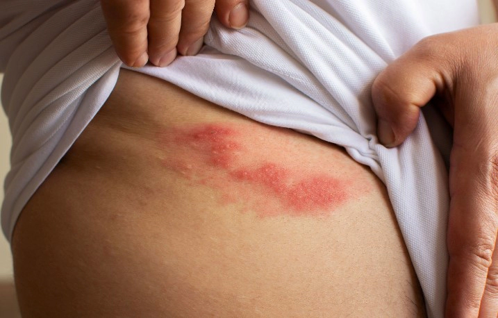 대상포진 초기증상 4가지 