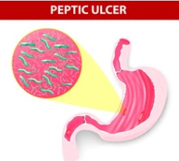 헬리코박터균 원인과 증상