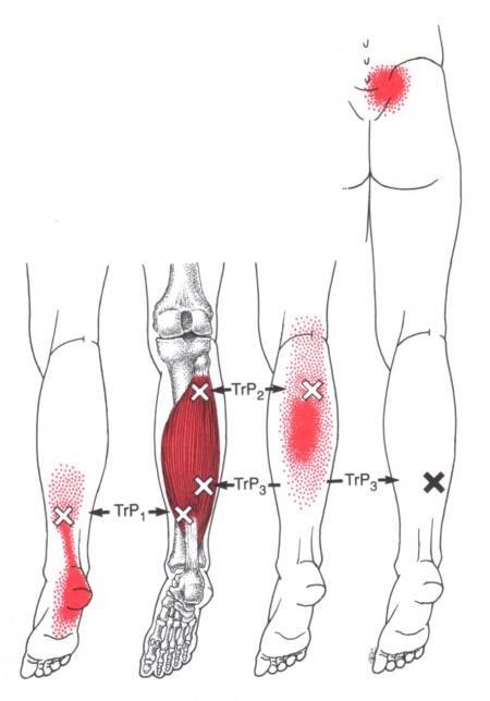비장근 (Soleus) 통증 유발점 위치