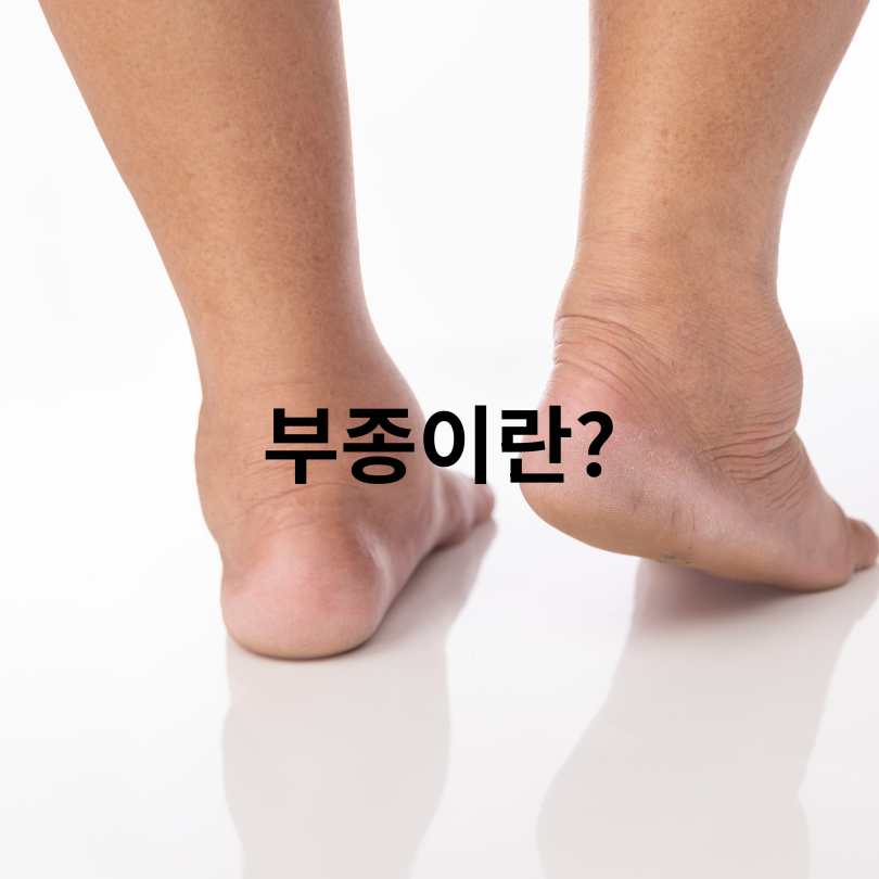 하루 5분! 부종 빼는 음식과 부종 빼는 습관