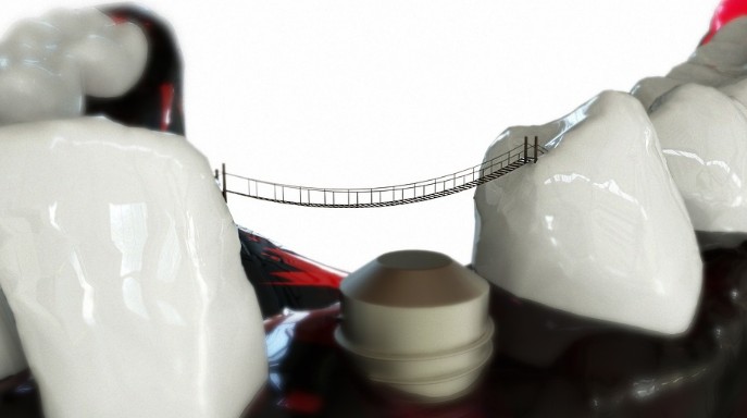 임플란트 치료기간, 임플란트 수명, 국산품 수입품 차이점, 임플란트 수술 후 부작용 합벼증 통증 음주 흡연