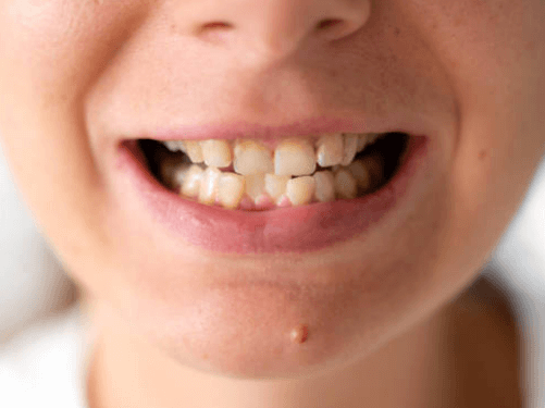 과개교합-치료-안하면