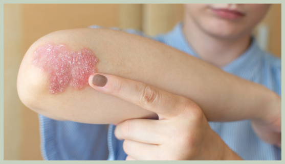 피부 건선 치료 방법