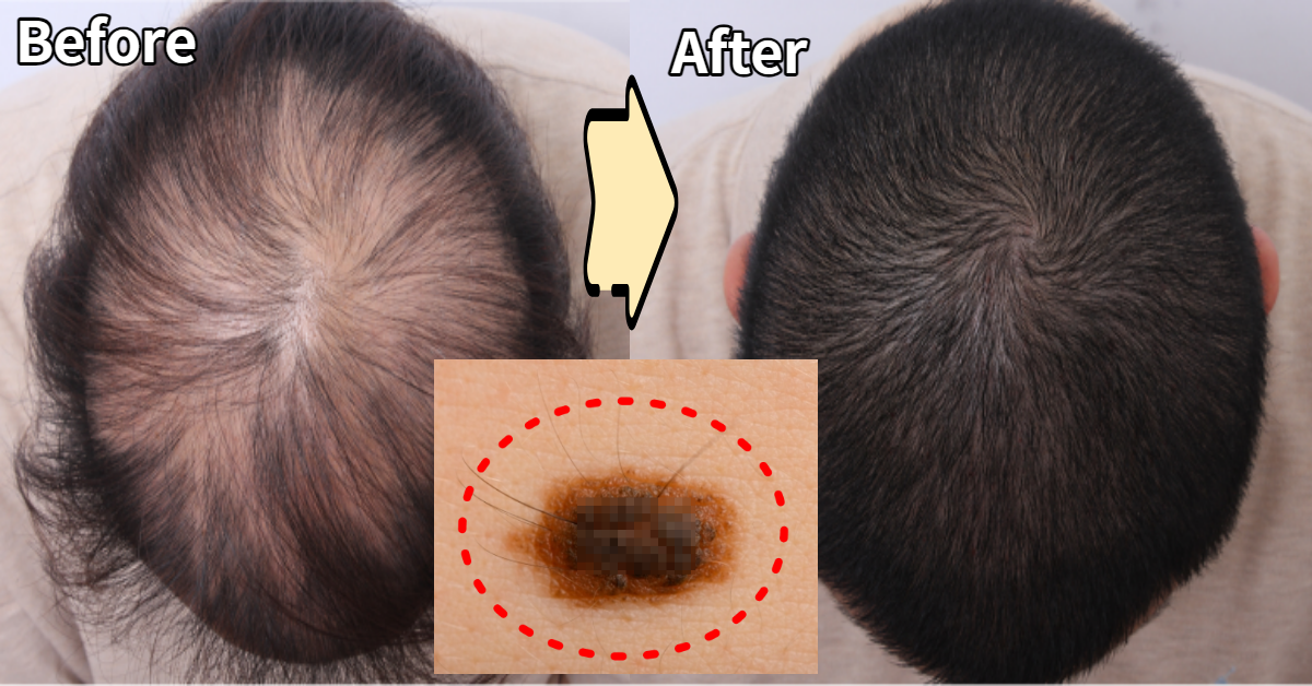 '이것'을 이용하면 보톡스처럼 주사 가능한 탈모치료법 찾았다.