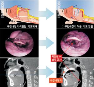 코골이 수술