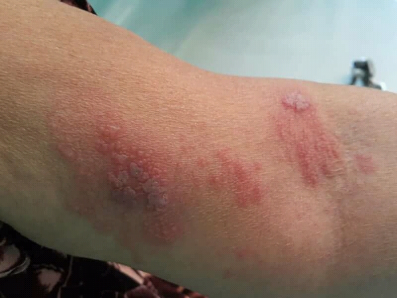 대상포진 초기증상