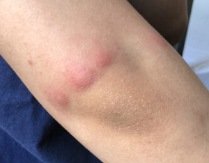 모기 물려서 가려울 때