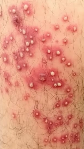 모낭염 원인과 치료방법