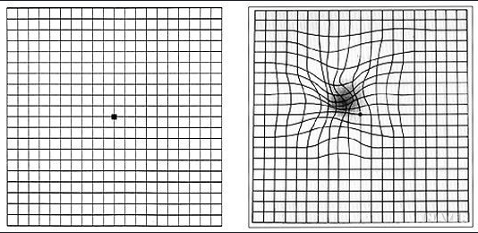 황반변성 체크하기