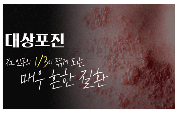 대상포진 전인구 3분의1은 겪는 매우 흔한 질환