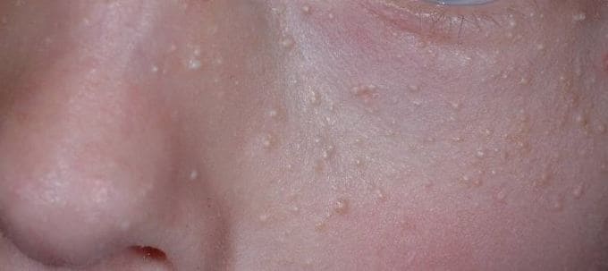 피부에-있는-좁쌀-여드름