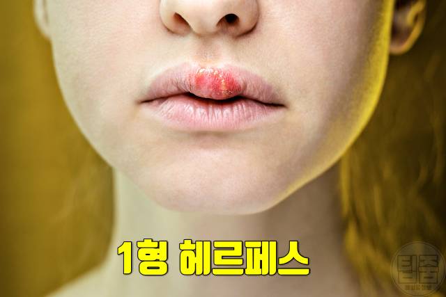 과로증상 피곤하면 입술물집 혈뇨 쌍커풀 귀가멍멍 코피 코골이 두드러기