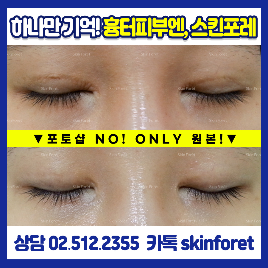 스킨포레 쌍꺼풀 흉터 전후 비교 사진