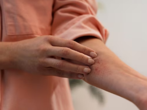 두드러기 가라앉히는 법