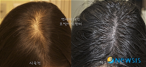 여자정수리- 탈모- 증상