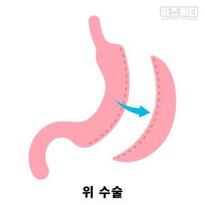 비타민 결핍 빈혈