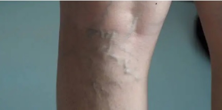 하지정맥류 관련 사진