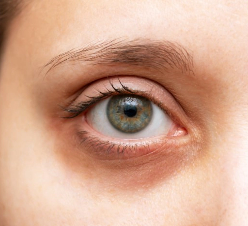 다크 서클 없애는법 9가지 및 다크서클에좋은음식 추천