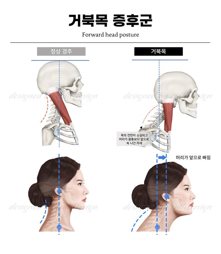 거북목 증후군