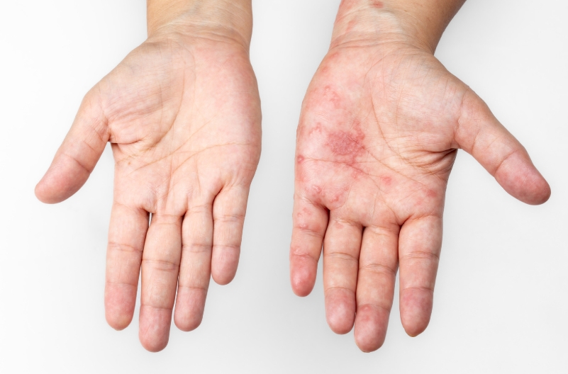 대상포진 주의사항 (초기증상, 예방접종, 회복)