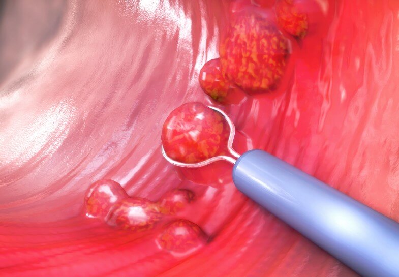 용종 제거 모습