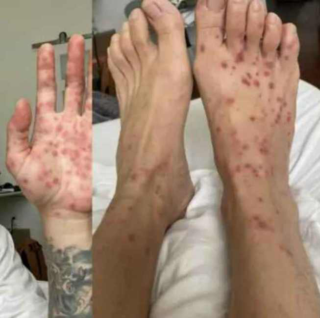 원숭이두창 증상