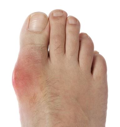 통풍-초기-증상