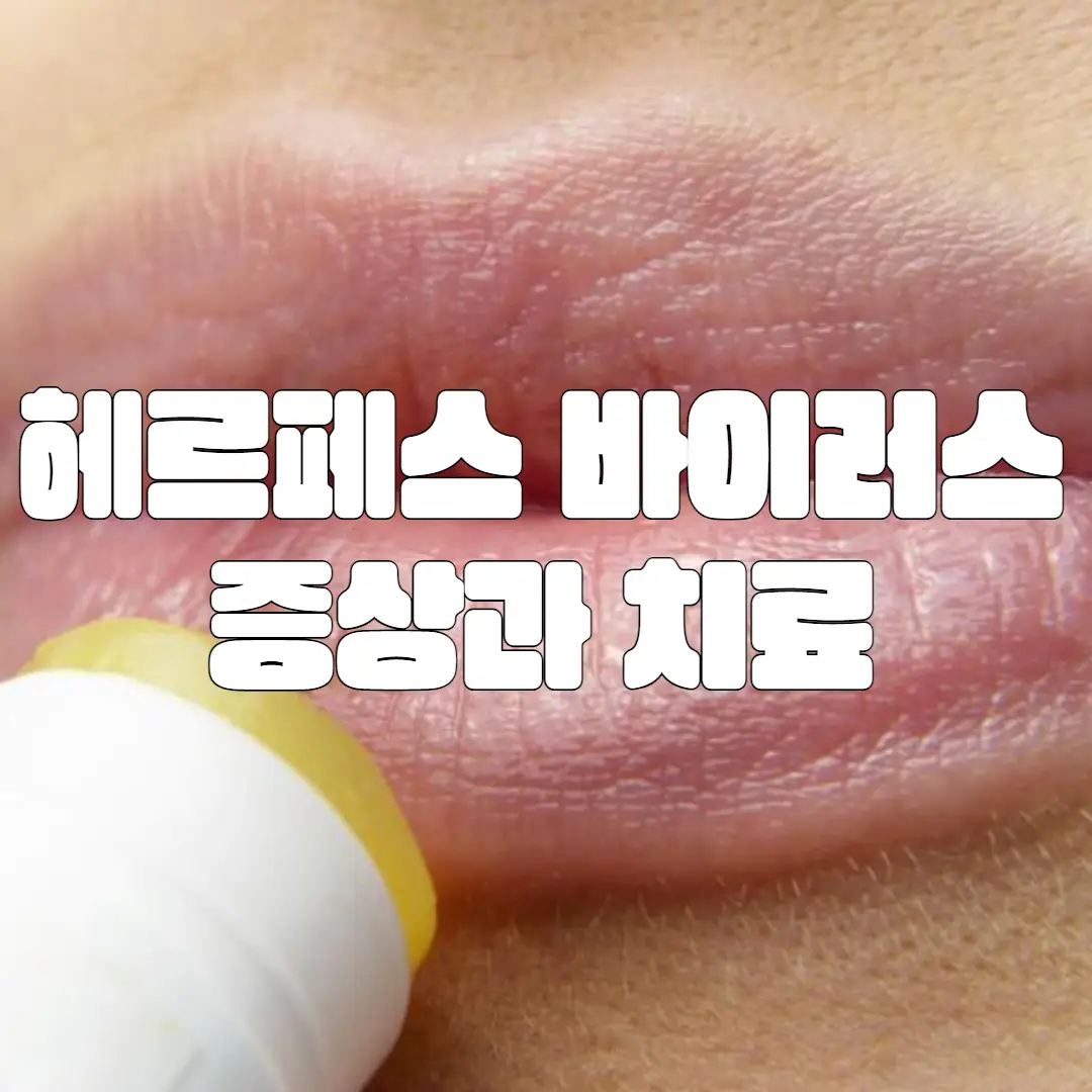 헤르페스 바이러스 종류와 증상, 치료 방법